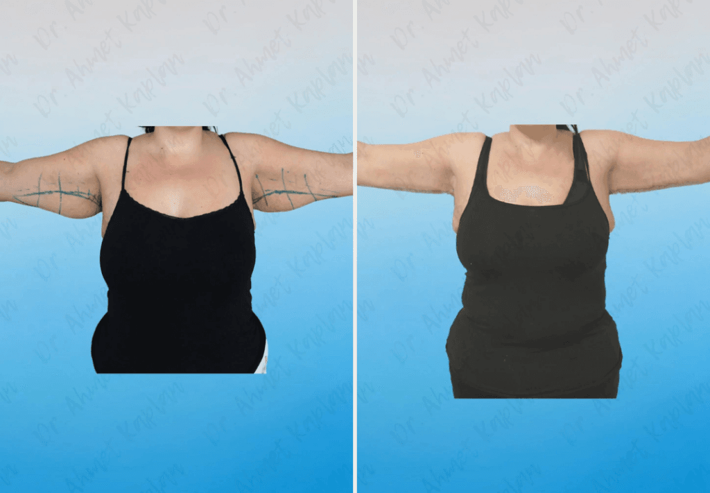 Arm Lift Surgery in Turkey