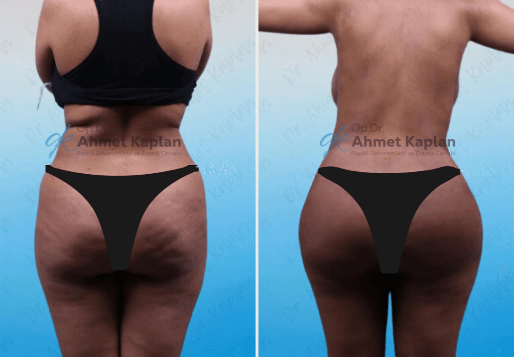 BBL in Turkey (Brazilian Butt Lift)​ (12)