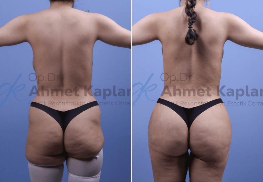BBL in Turkey (Brazilian Butt Lift)​ (2)