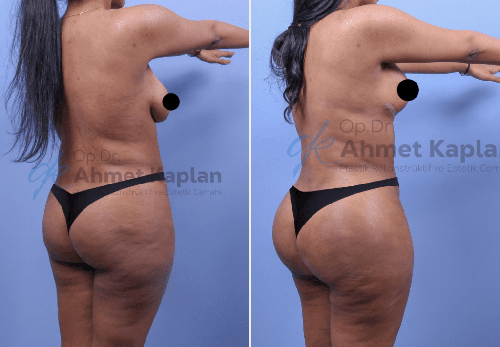BBL in Turkey (Brazilian Butt Lift)​ (3)