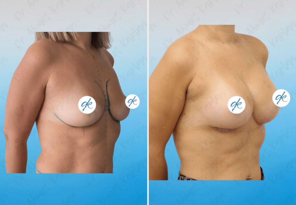 Breast Augmentation in Turkey