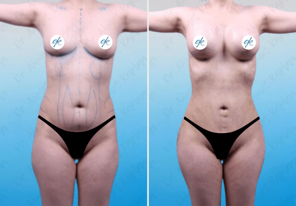 Breast Augmentation in Turkey