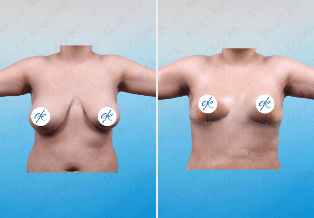 Breast Lift Surgery in Turkey