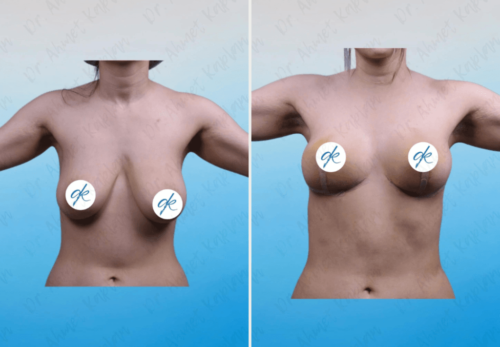Breast Lift Surgery in Turkey