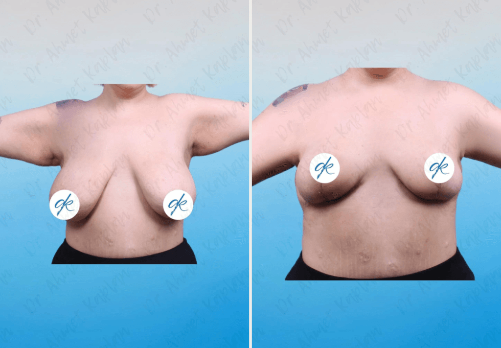 Breast Lift Surgery in Turkey