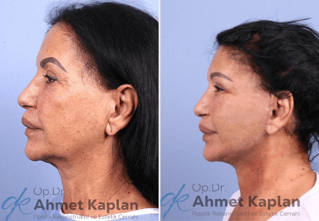 Face Lift Surgery in Turkey