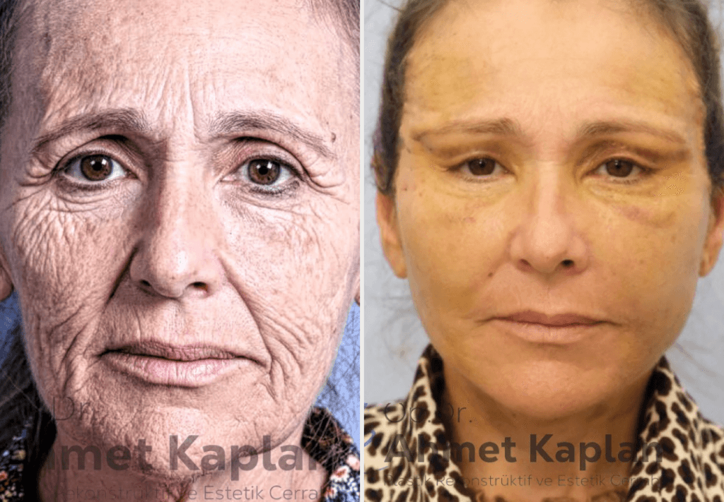 Face Lift Surgery in Turkey