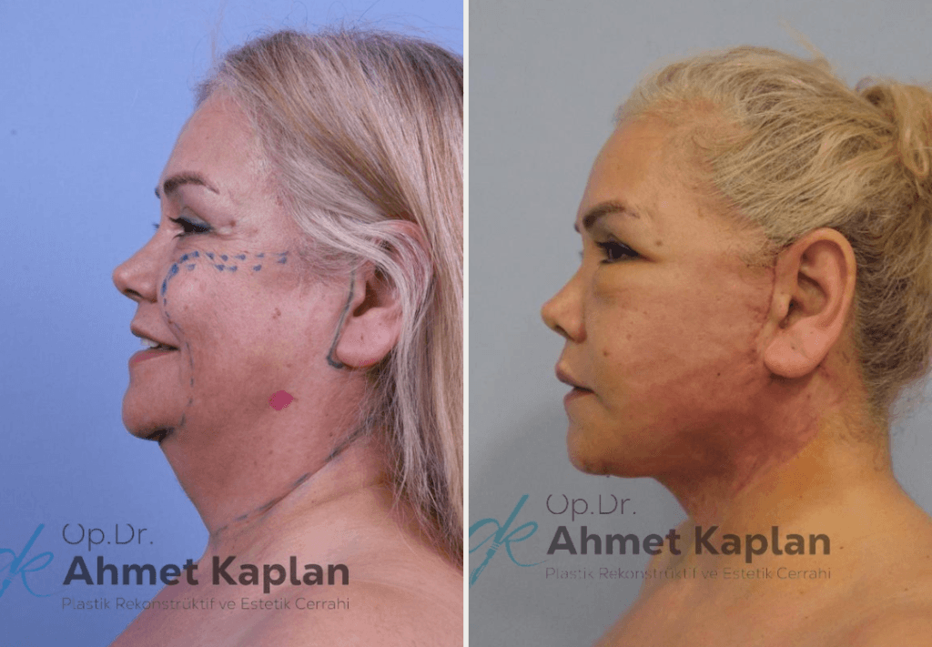 Face Lift Surgery in Turkey