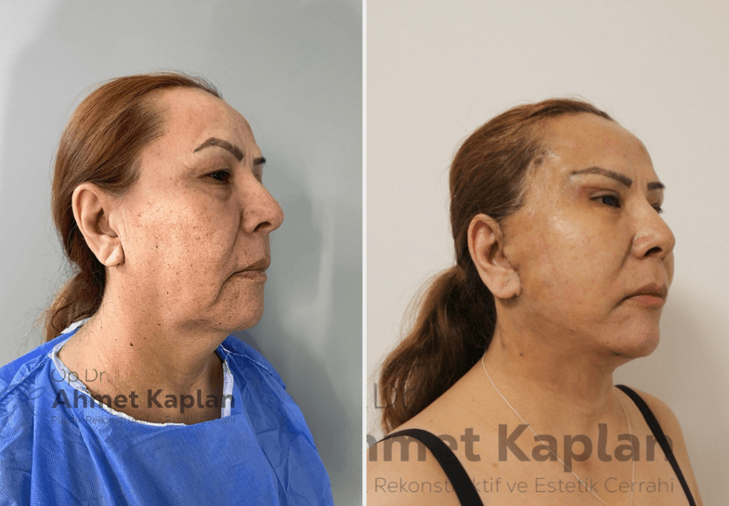 Face Lift Surgery in Turkey