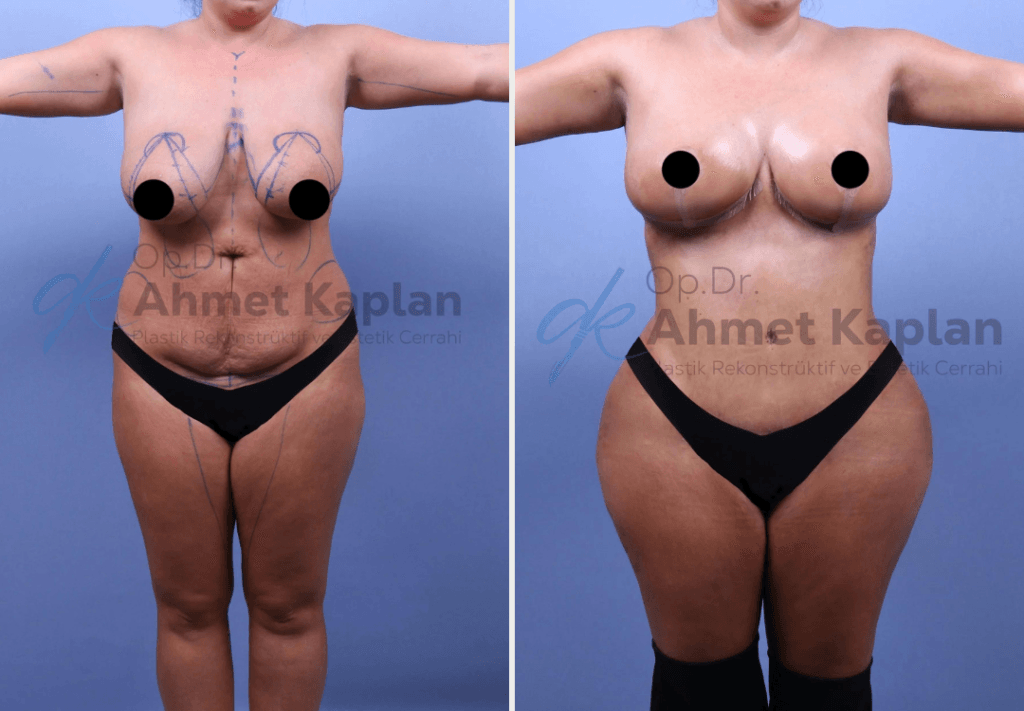Mommy Makeover in Turkey (5)
