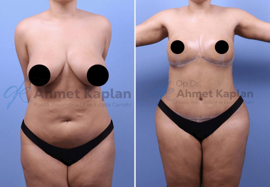 Mommy Makeover in Turkey (6)