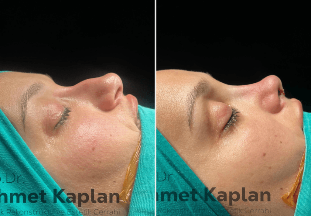 Rhinoplasty in Turkey