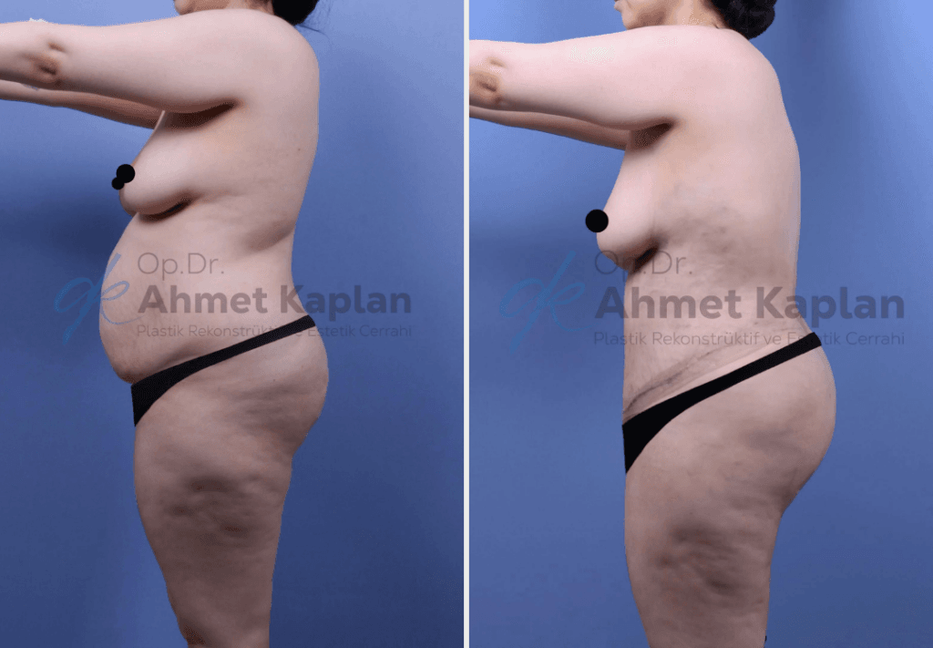 Tummy Tuck Surgery in Turkey (2)