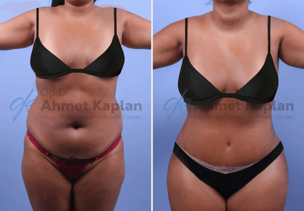 Tummy Tuck Surgery in Turkey (3)