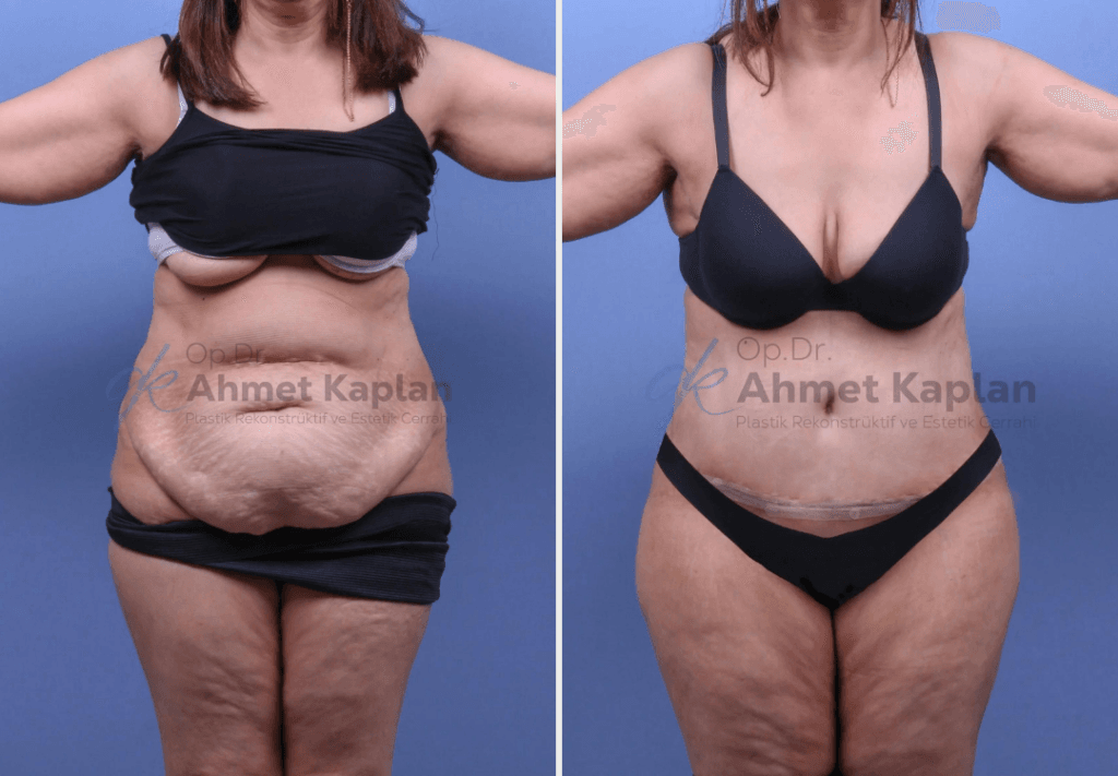 Tummy Tuck Surgery in Turkey (5)