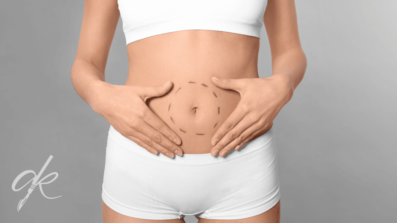 Was ist eine Bauchdeckenstraffung und wie wird sie durchgeführt?