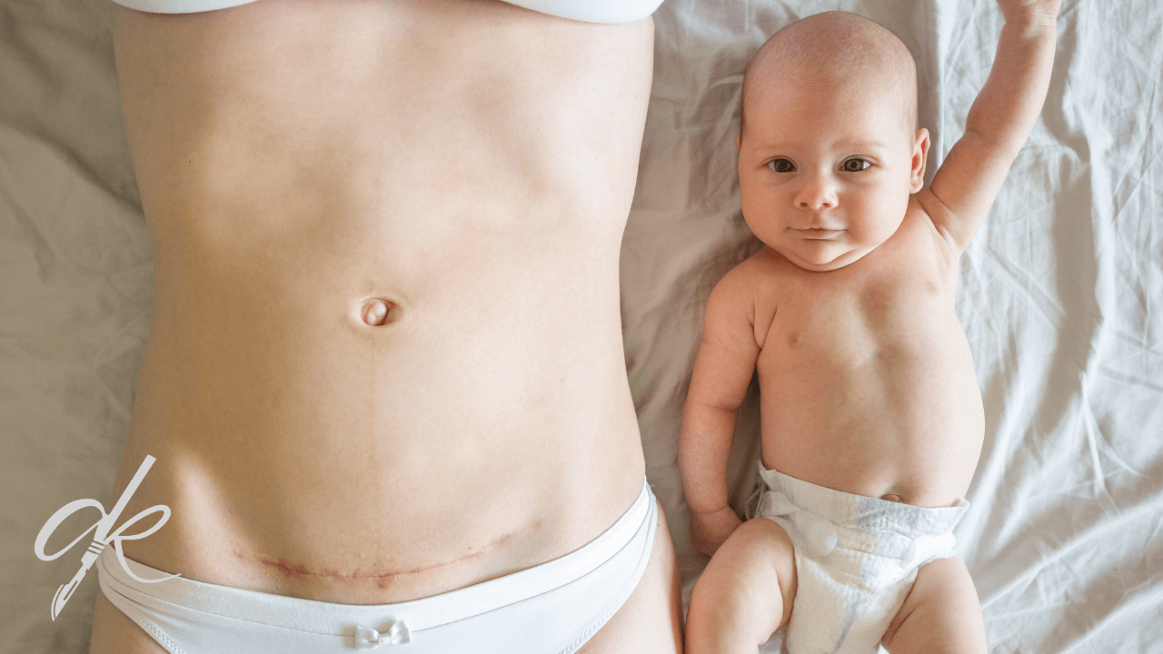 Preise für Mommy Makeover (Mütterliche Schönheitsoperation) 2025