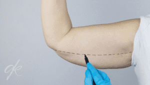 Nahtlose Armstraffung vs. Klassische Armstraffung Ein Vergleich von Dr. Ahmet Kaplan