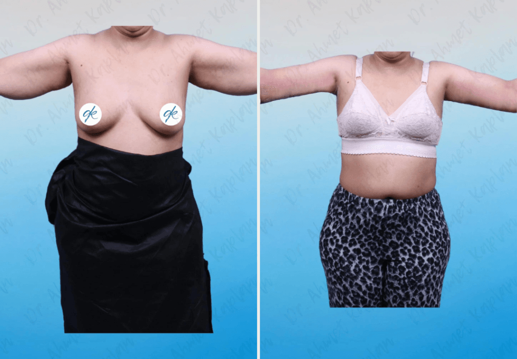 Arm Lift Surgery in Turkey