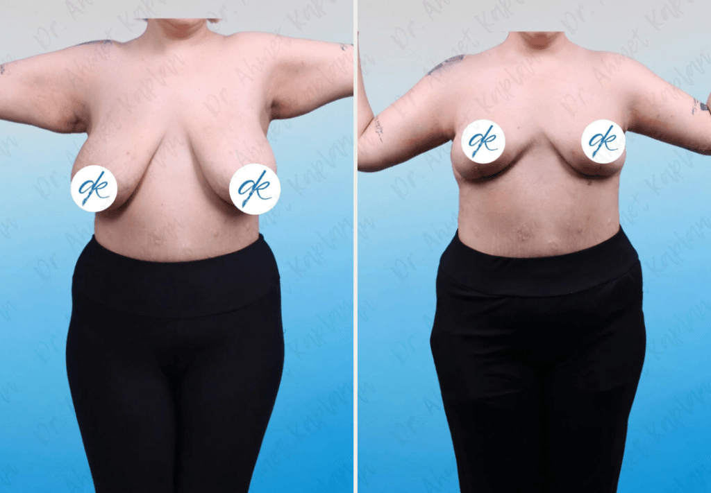 Arm Lift Surgery in Turkey