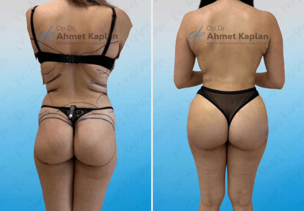 BBL in Turkey (Brazilian Butt Lift)​ (9)