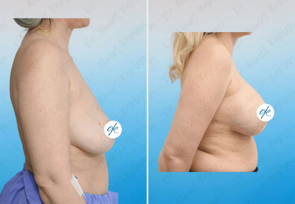 Breast Augmentation in Turkey