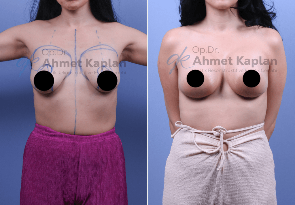 Breast Lift & Augmentation Surgery in Turkey