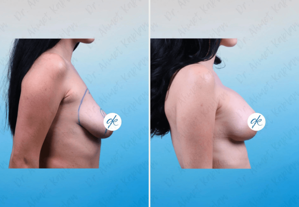 Breast Lift & Augmentation Surgery in Turkey