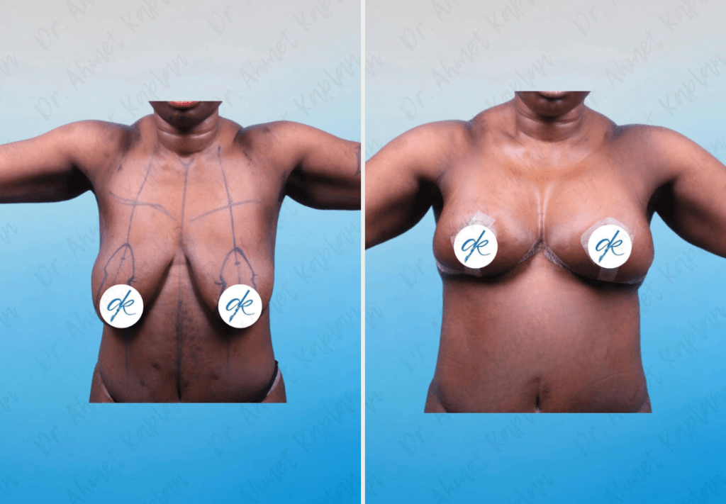 Breast Lift Surgery in Turkey