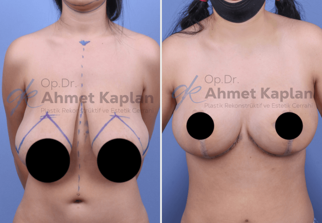 Breast Lift Surgery in Turkey