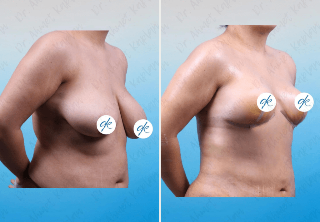 Breast Lift Surgery in Turkey