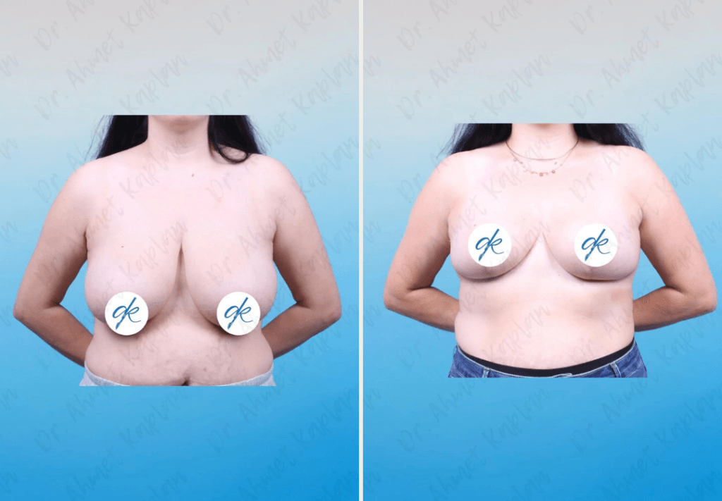 Breast Lift Surgery in Turkey