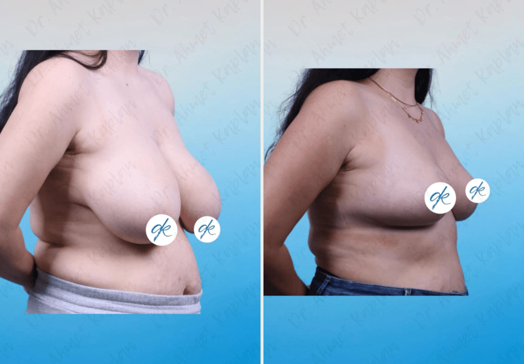 Breast Lift Surgery in Turkey