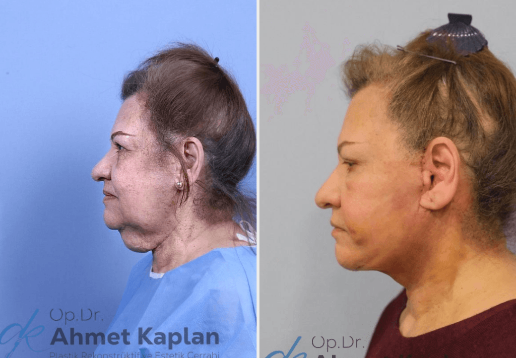 Face Lift Surgery in Turkey