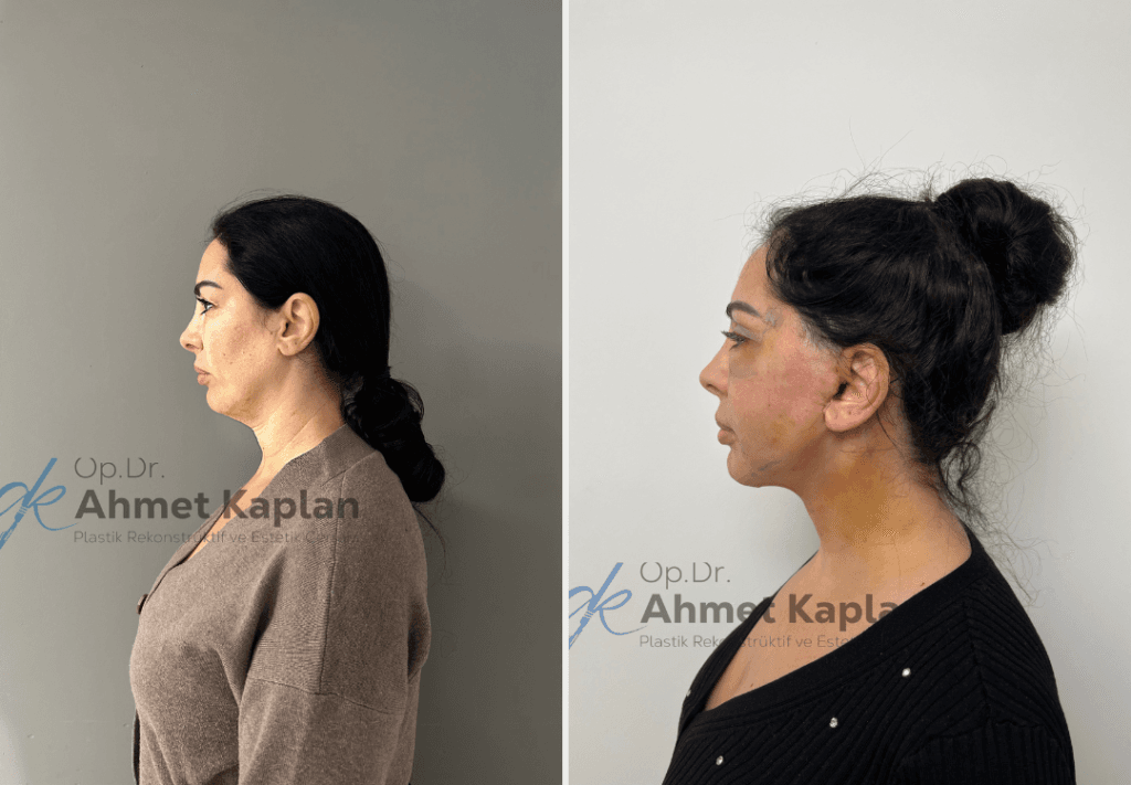Face Lift Surgery in Turkey