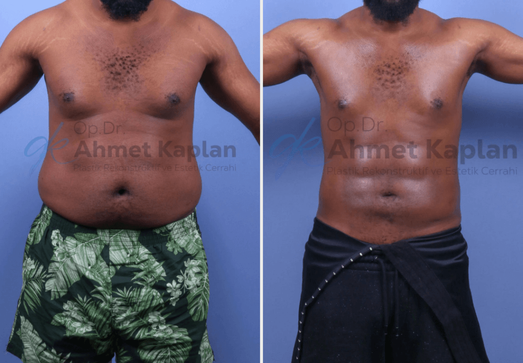 Male Aesthetics in Turkey