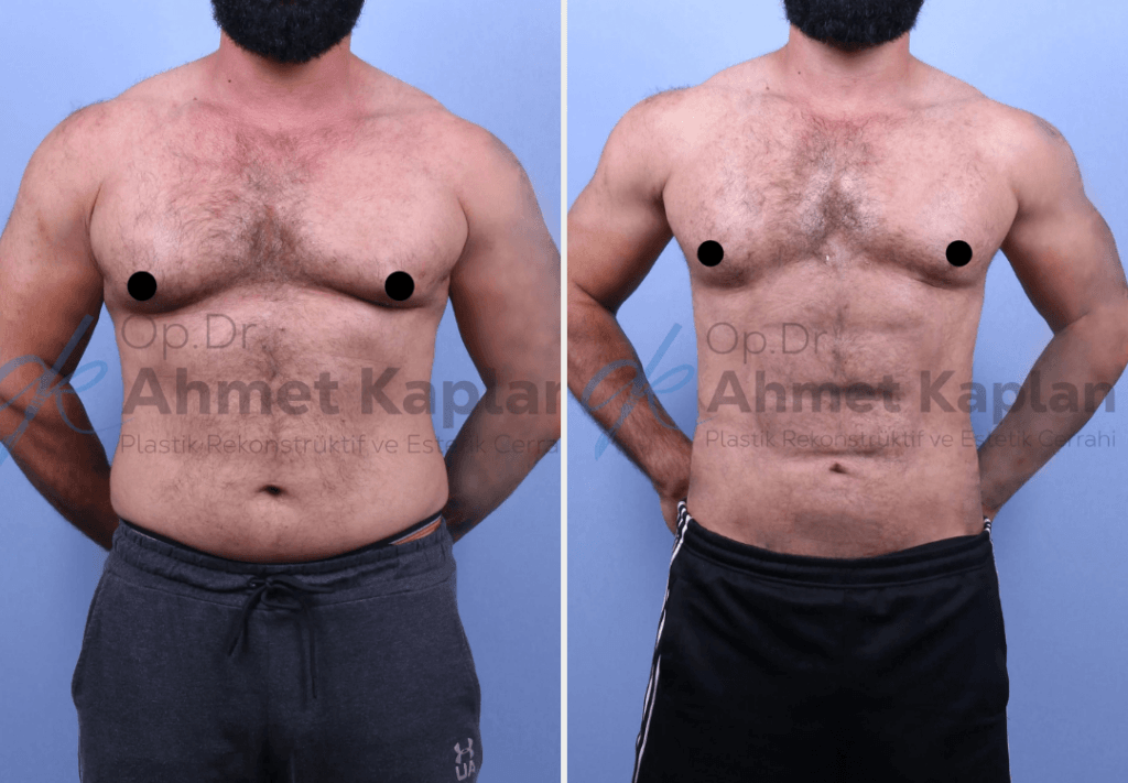 Male Aesthetics in Turkey