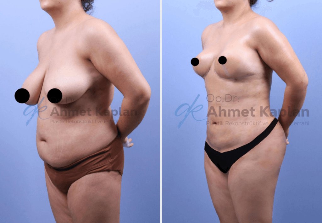 Mommy Makeover in Turchia