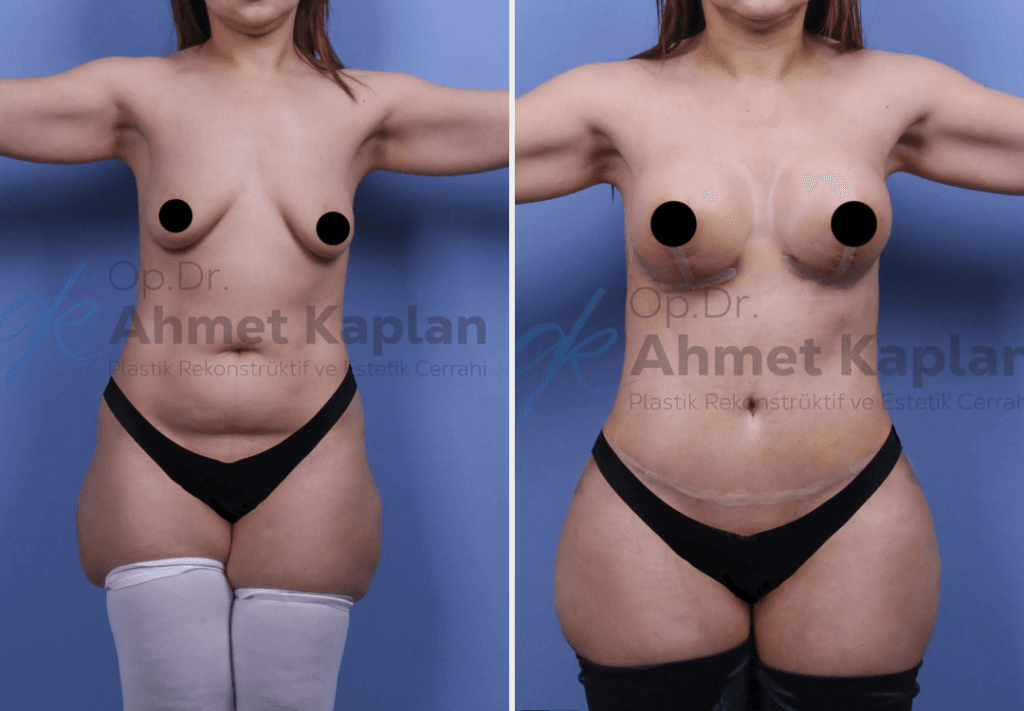 Mommy Makeover in Turkey (3)