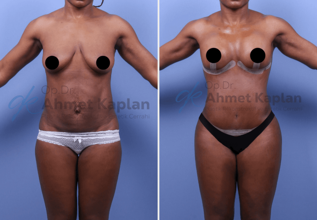 Mommy Makeover in Turkey (9)