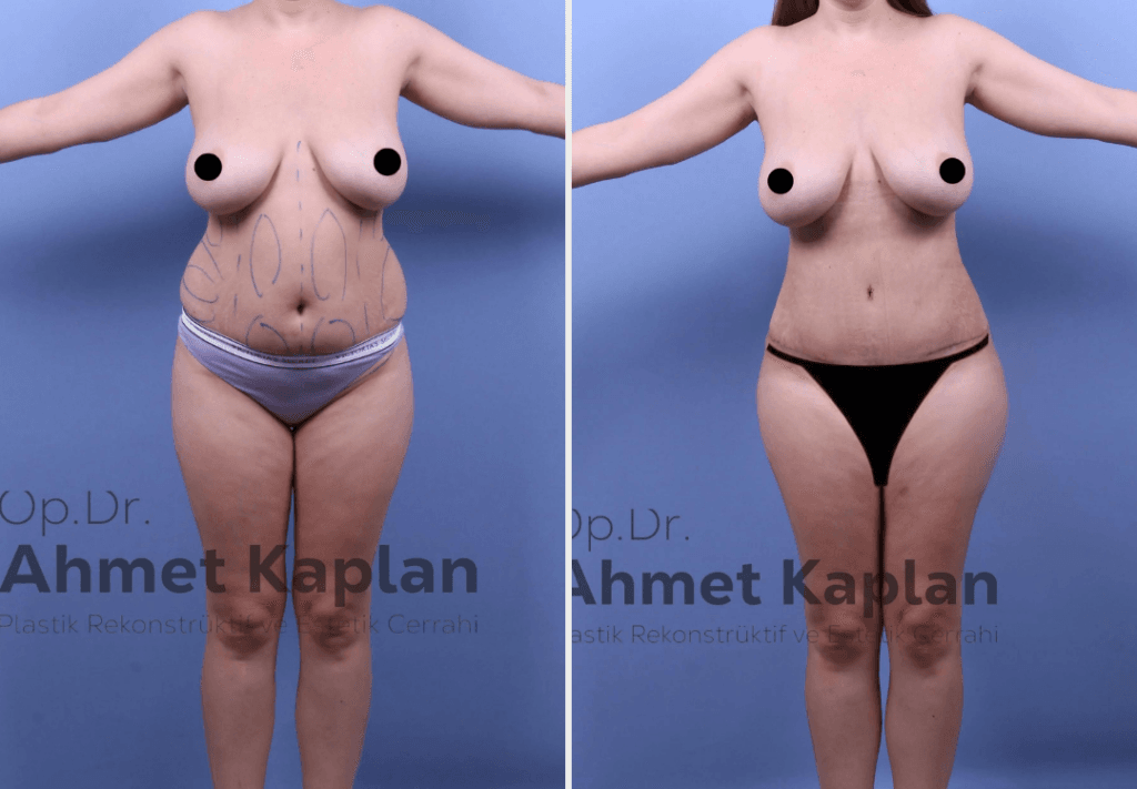 Tummy Tuck Surgery in Turkey (1)