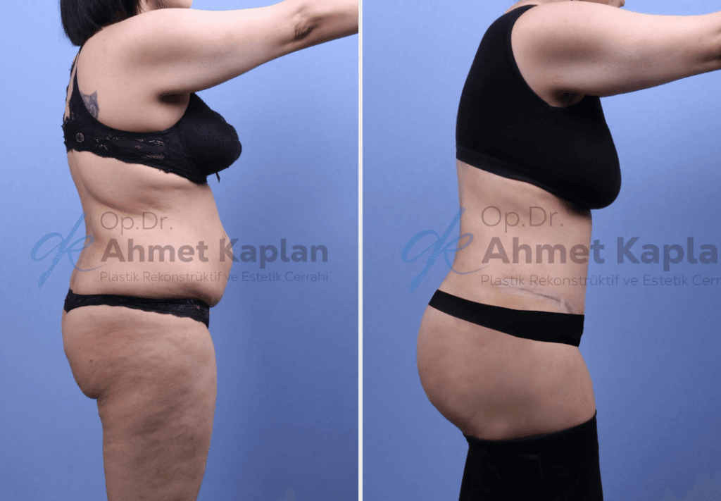 Tummy Tuck Surgery in Turkey (6)
