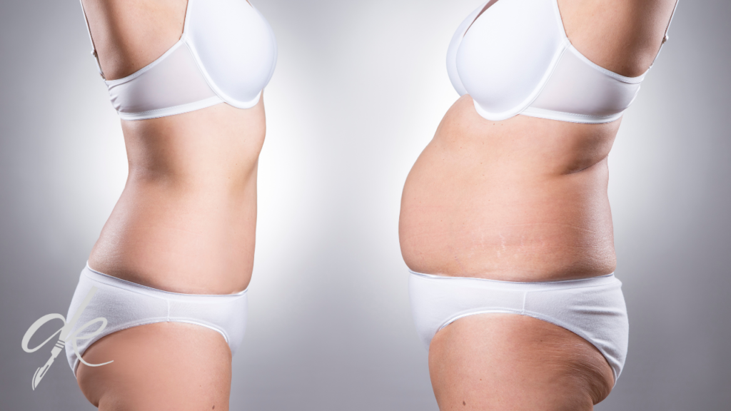 Che cos'è la Liposuzione? Come si Esegue?