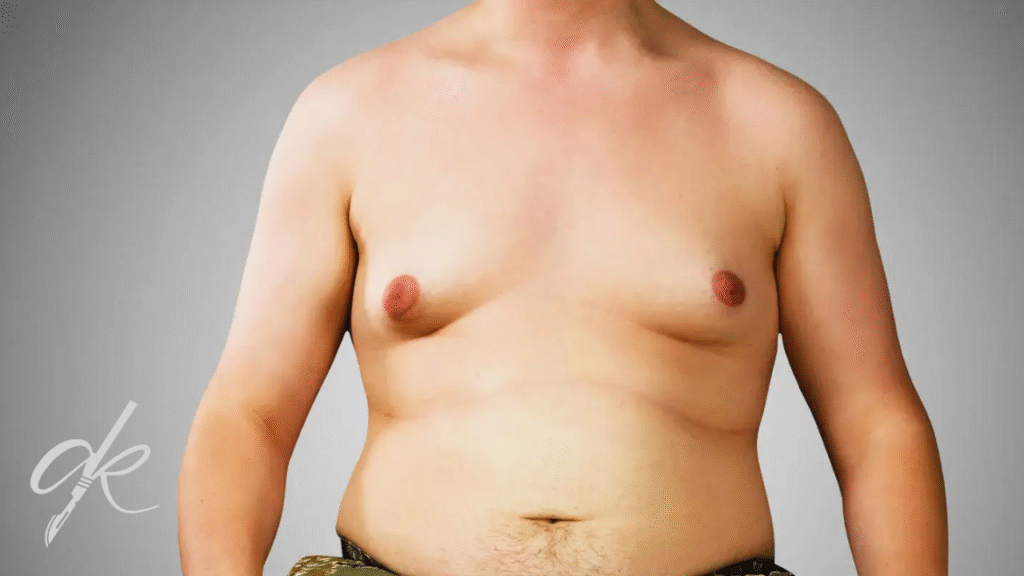 Come Dovrebbe Essere la Cura della Cicatrice Dopo l'Intervento di Ginecomastia?