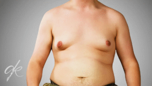 Come Dovrebbe Essere la Cura della Cicatrice Dopo l'Intervento di Ginecomastia?