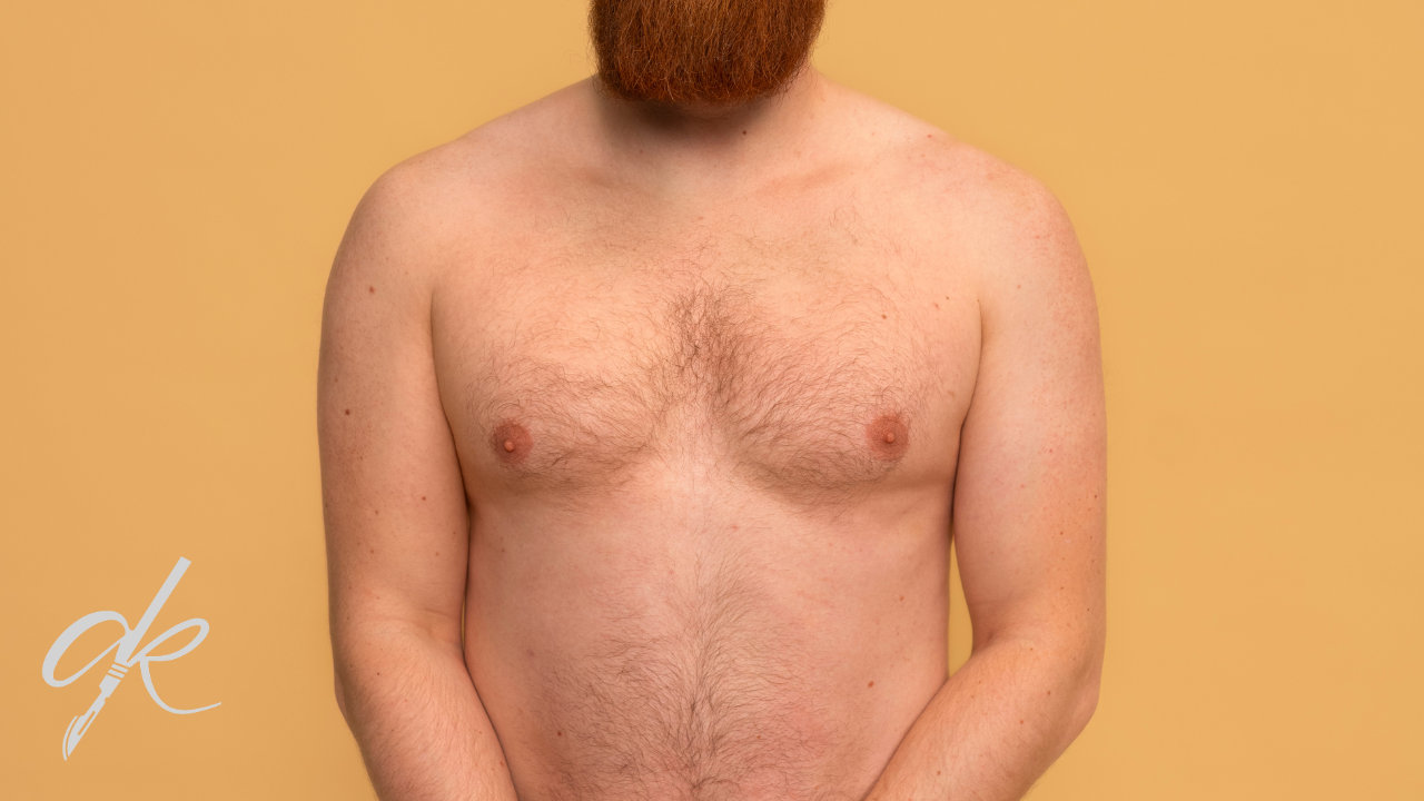 Ginecomastia