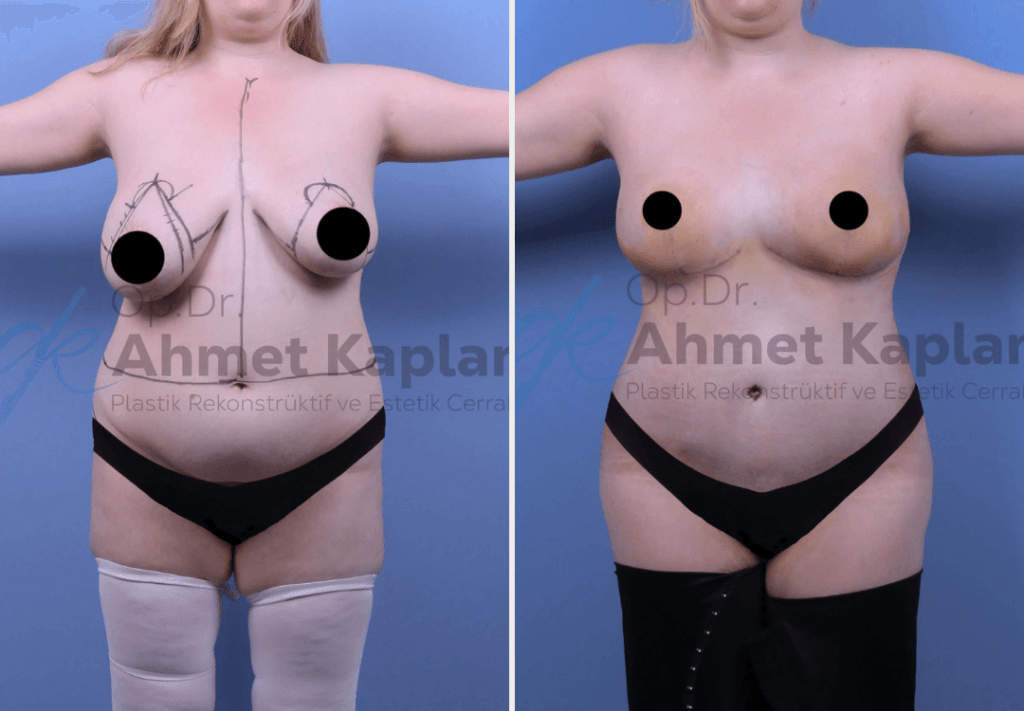 До - После / Операция «Mommy Makeover» в Турции