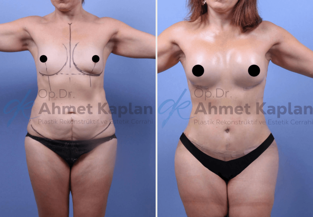 До - После / Операция «Mommy Makeover» в Турции