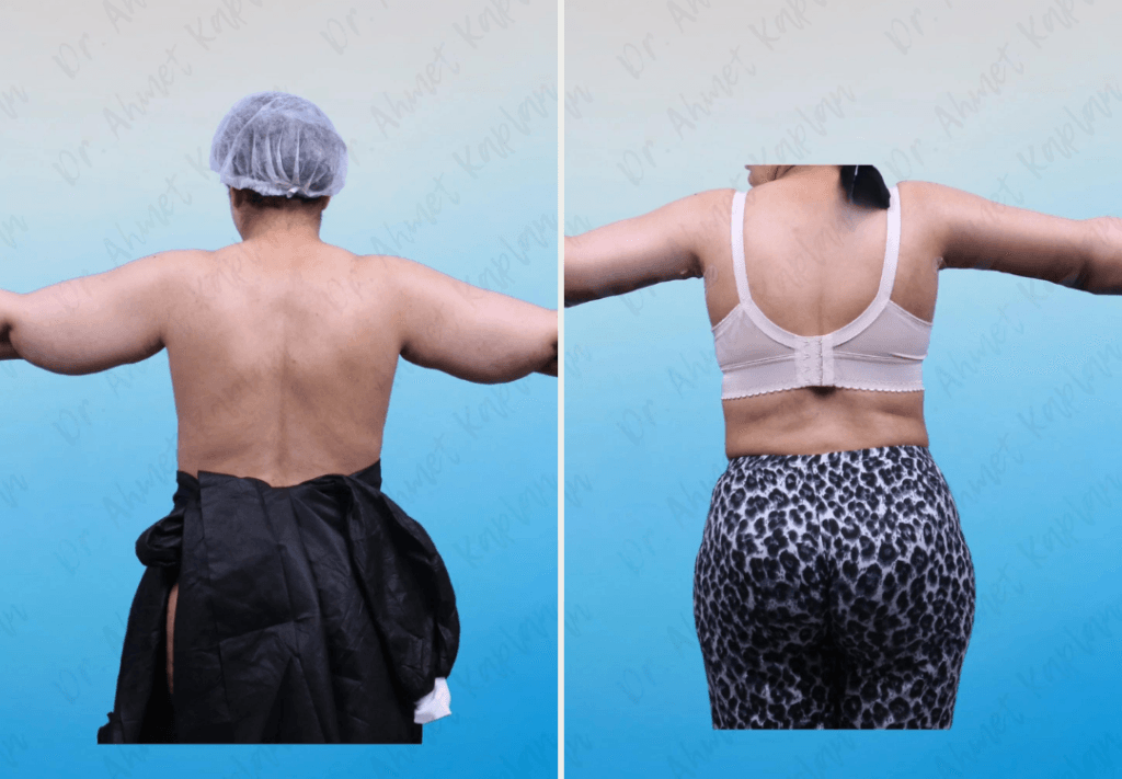 Arm Lift Surgery in Turkey