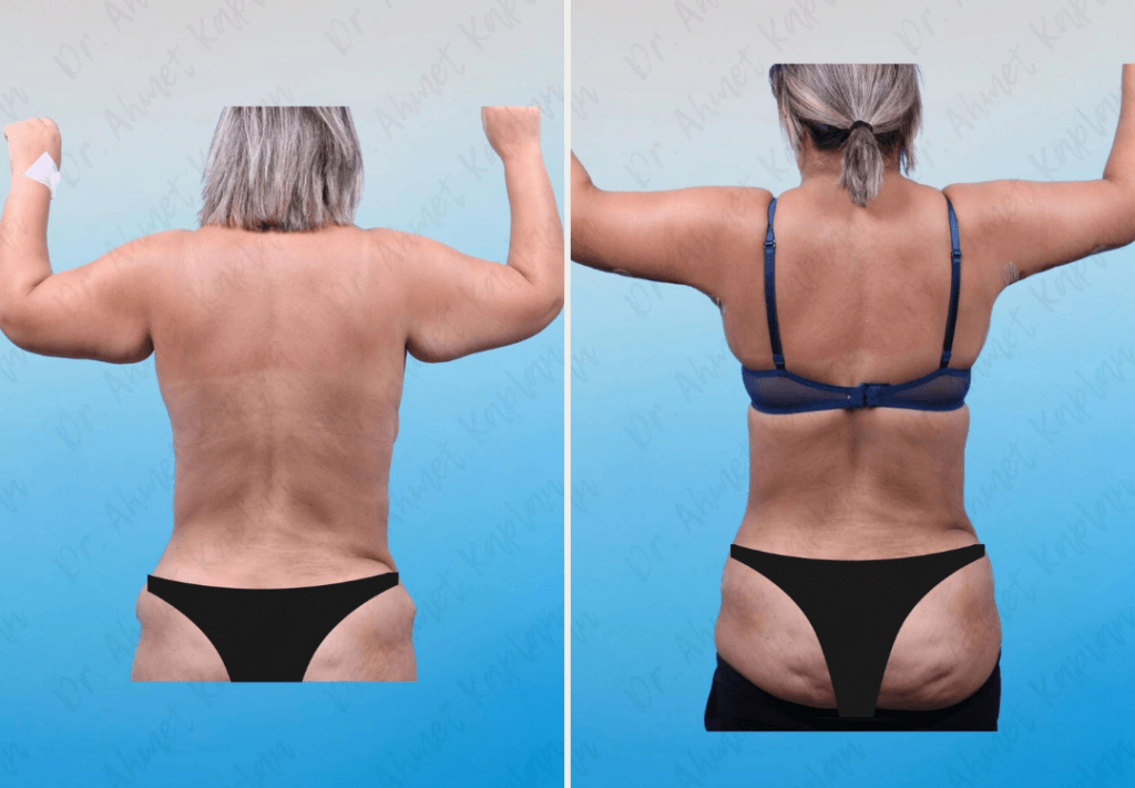Arm Lift Surgery in Turkey